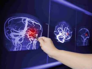 How to Find the Best Brain Injury Attorney in Corpus Christi