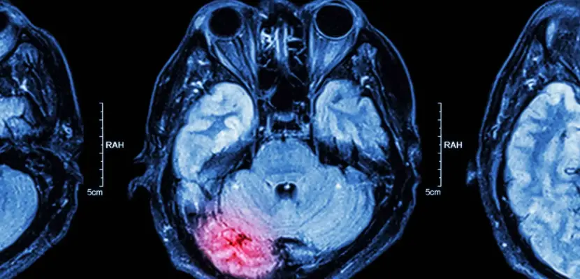 TBI Traumatic Brain Injury Lawyers scaled 1