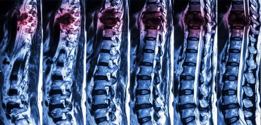spinal cord injury attorneys img
